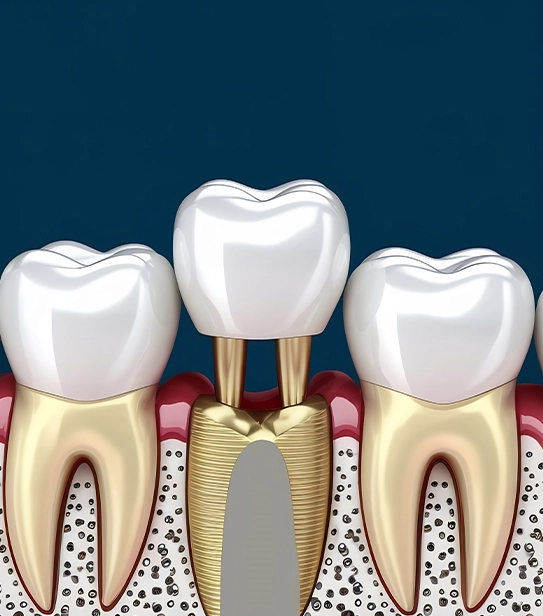 Illustration of a dental bridge supported by implants used to replace a missing tooth and restore dental function.