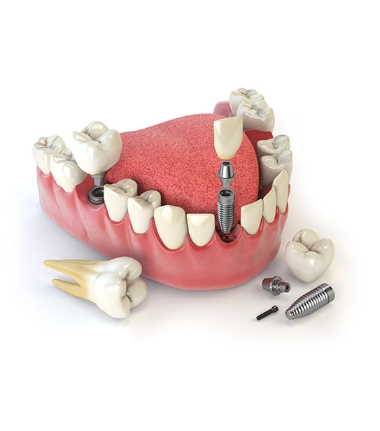 3D illustration of dental implants and replacement teeth in a gum model.