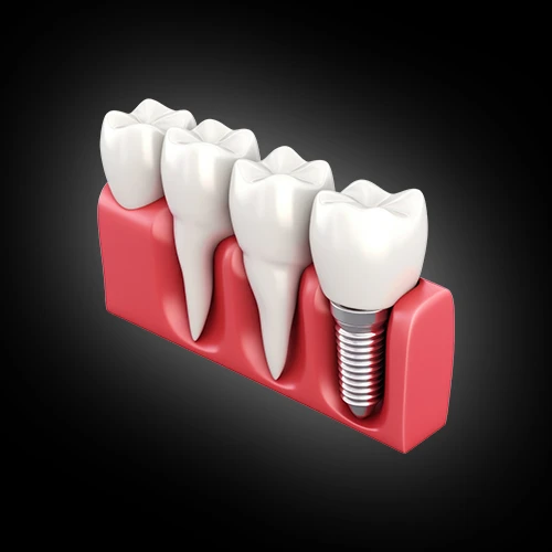 3D illustration of dental implants with teeth in a gum model