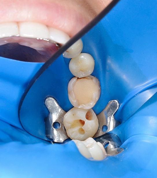 Close-up of a molar with a missing filling and visible cavity during dental treatment with rubber dam isolation.