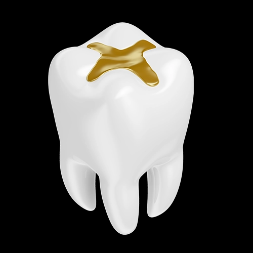 Molar tooth with composite filling restoration on the chewing surface isolated on black background