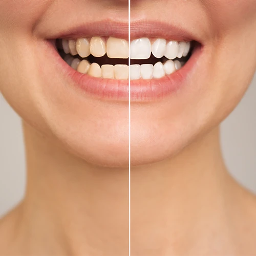 Visual results of professional teeth whitening treatment comparing stained enamel to a bright white smile.