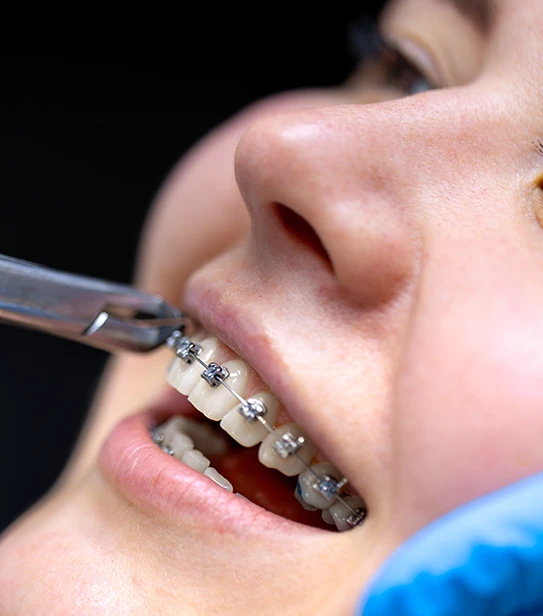 Orthodontic procedure showing the professional application of metal dental brackets for teeth alignment.