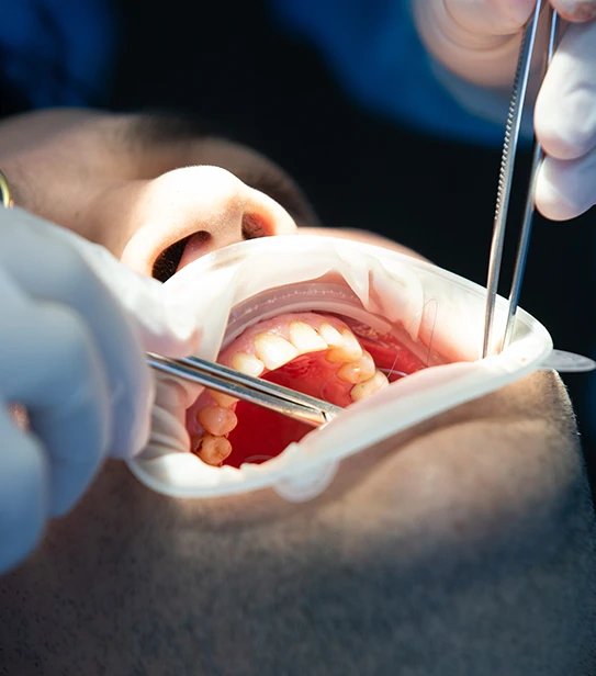 Close-up of a patient undergoing a dental surgical operation with a cheek retractor and surgical tools in use by a dentist.