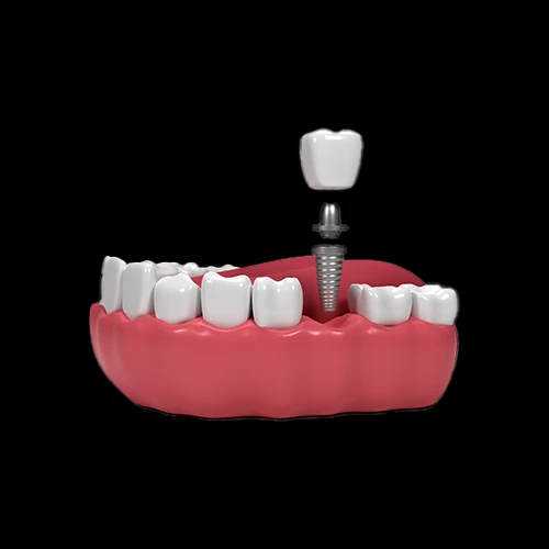 A 3D anatomical rendering of a dental implant showing the titanium screw post, abutment, and porcelain crown being placed into the gum line.
