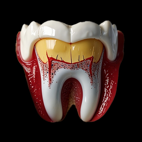 Illustration of infected tooth with swelling and inflammation at the root and gums