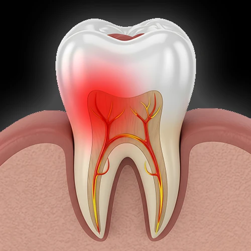 Anatomical diagram of tooth pulp inflammation and infection caused by deep dental decay or a cavity.