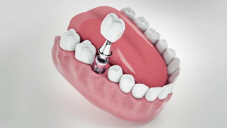 Dental Implants