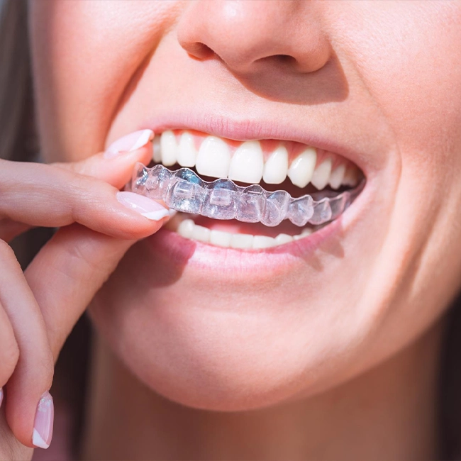 invisalign